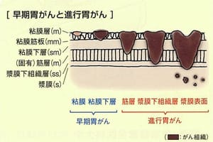 早期胃がんと進行胃がん