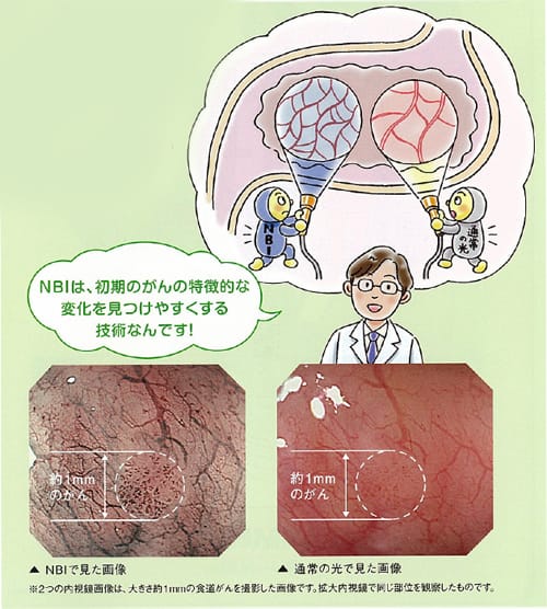 NBIは、初期のがんの特徴的な変化を見つけやすくする技術なんです！